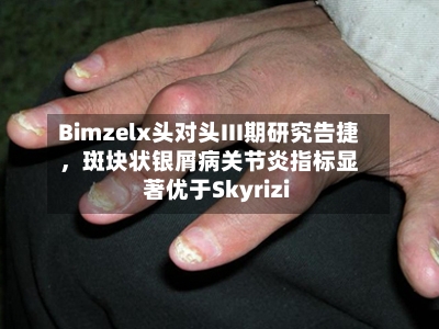 Bimzelx头对头III期研究告捷，斑块状银屑病关节炎指标显著优于Skyrizi-第2张图片