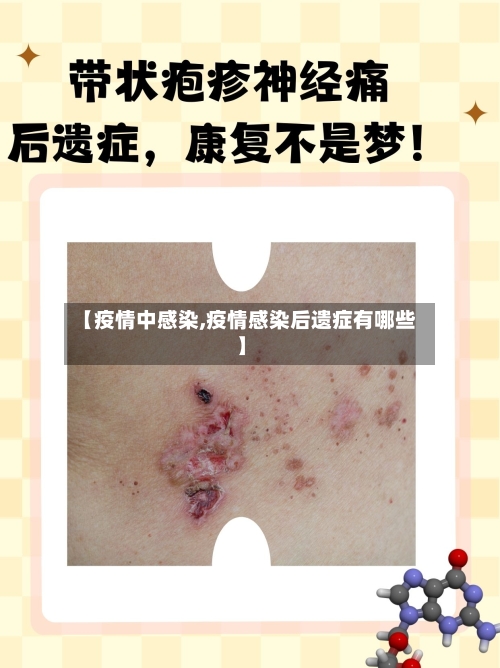 【疫情中感染,疫情感染后遗症有哪些】